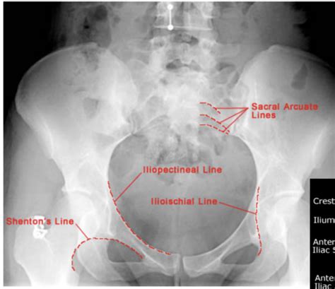 Diagnostic Imaging Hip Pelvis Flashcards Quizlet