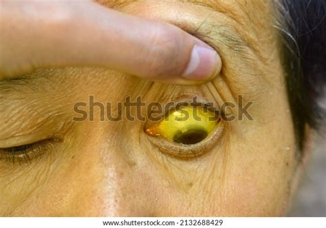 363 Yellow Eyes Asian Disease Images Stock Photos Vectors Shutterstock