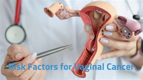 Vaginal Cancer Prevention And Treatment 2023