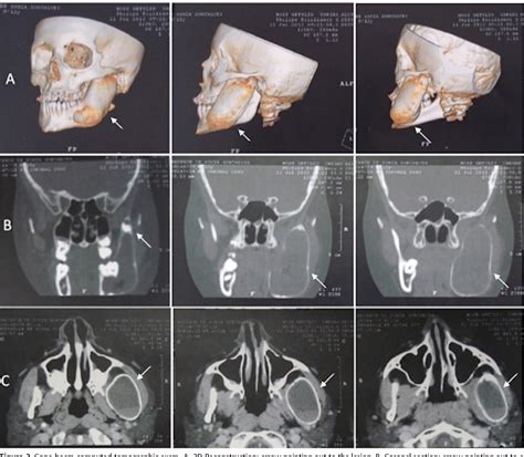 Figure From Conservative Approach Of An Unicystic Ameloblastoma On A