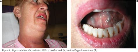 Figure From Warfarin Induced Sublingual Hematoma Mimicking Ludwig