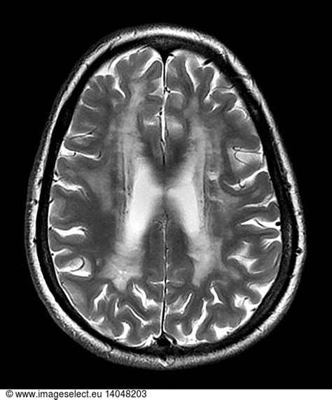 MRI of CADASIL MRI of CADASIL,abnormal mri brain,brain lesion,CADASIL ...