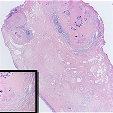 Hematoxylin And Eosin Staining Images Of Resected Diverticulum At 200×