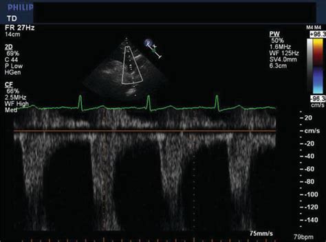 The Adult With Coarctation Of The Aorta Intechopen