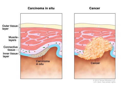 Cancer: types of tumors, carcinogenesis, diagnosis of CA, & Rx of CA. | Strive For Good Health