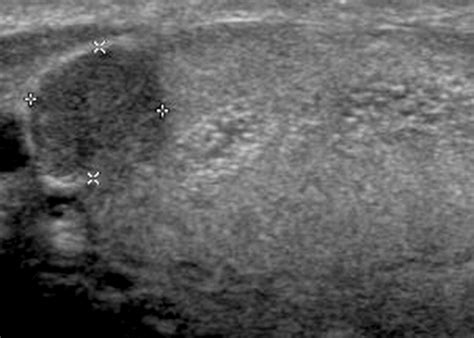 Gamut Of Extratesticular Scrotal Masses Anatomic Approach To