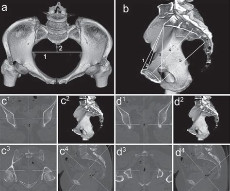 Representative 3D and reformatted CT images of gynecoid pelvis... | Download Scientific Diagram