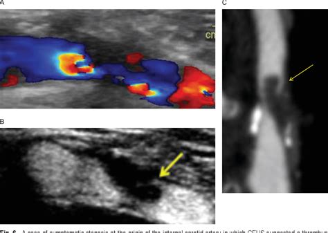 Figure 1 From Carotid Artery Plaque Diagnosis Ultrasound Diagnosis Of Carotid Plaques Semantic