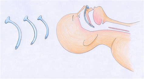 Nasopharyngeal Airway Critical Care Nursing Nursing Tips Eye Anatomy