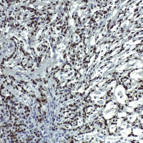 Mmunostaining For S Showing Diffuse Nuclear And Cytoplasmic