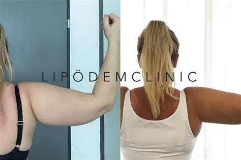 Lipödem Bilder LIPÖDEMCLINIC