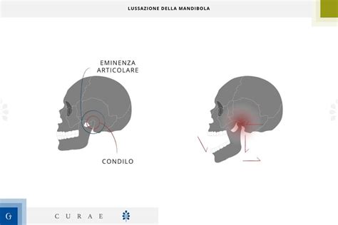 Lussazione Mandibola Sintomi Cause E Manovra Di Riduzione