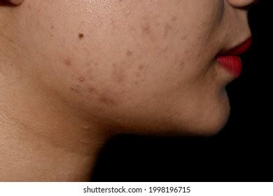 Chloasma Melasma Black Spots Acne Scars Stock Photo 1998196715