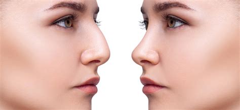 Revision Nose Surgery Secondary Rhinoplasty Rhinoplasty Nose