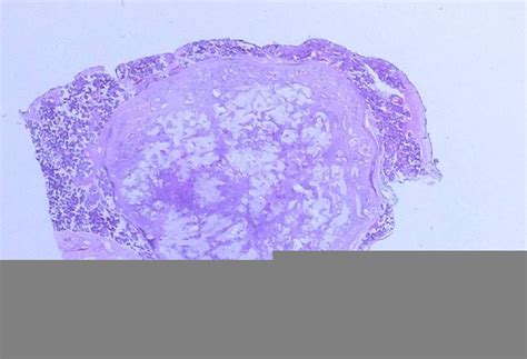 Figure 1 From Pleomorphic Adenoma With Extensive Mucinous Metaplasia