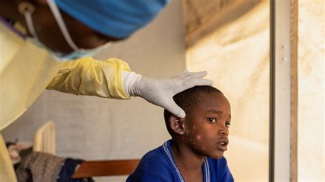 Sweden Yaripoti Kisa Cha Kwanza Cha Mpox