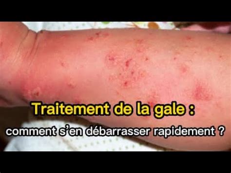 Traitement de la gale comment sen débarrasser rapidement YouTube