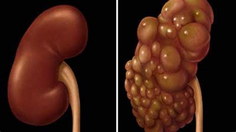 Poliquistosis Renal Enfermedad Que Todavía No Tiene Cura Pero Se