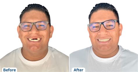 Dental Implants In Tijuana Mexico Best Dentist In Tijuana For Implants