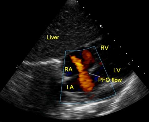 Pfo Flow All About Cardiovascular System And Disorders