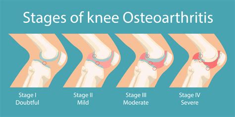 Osteoarthritis Stages Symptoms Causes Diagnosis And Treatment