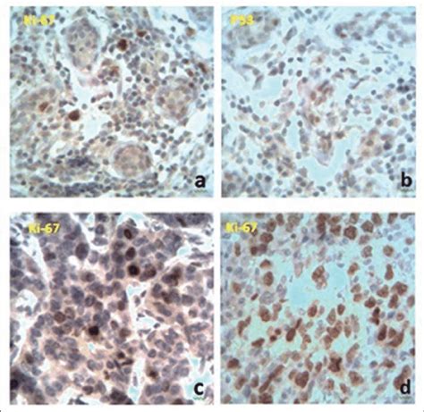 Immunohistochemical Expression Of Ki 67 And P53 Receptors A B Intact Download Scientific