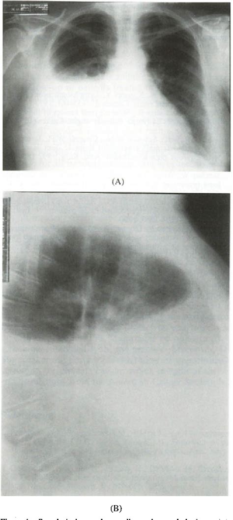 Figure 1 From Pulmonary Lymphangioleiomyomatosis A Case Report In