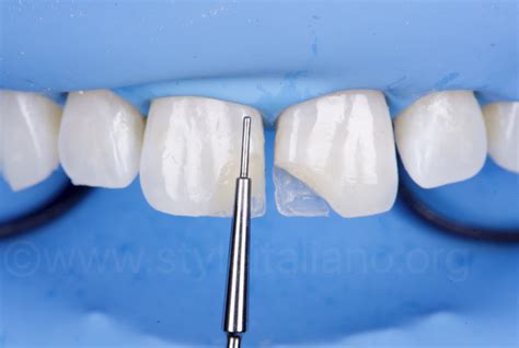 Composite Dental