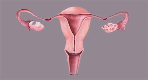 Pelvic Adhesions Natural Remedy For Fallopian Tube Blockage