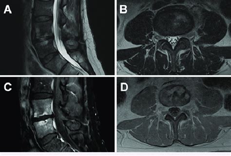 Mri Sequences Of Known L Discitis Osteomyelitis A And B T