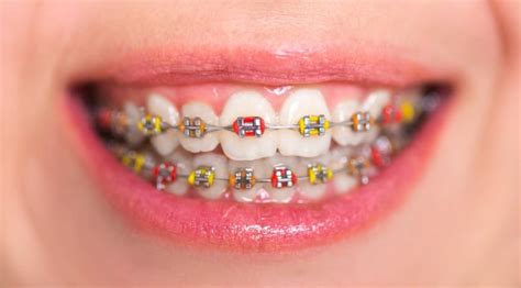 How To Pick The Best Braces Colors For Boys? - Health and Healthy Tips