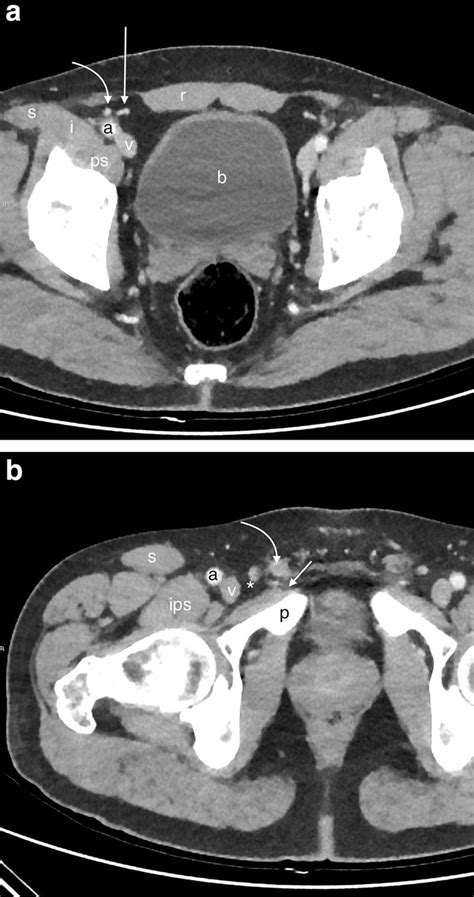 A Axial CT At The Level Of Deep Ring Cephalad To The External Iliac