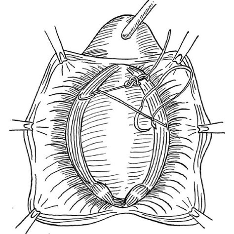 Pdf A Novel Technique For Anterior Vaginal Wall Prolapse Repair Anterior Vaginal Wall Darn