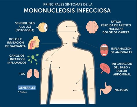 Mononucleosis Infekcijska Mononukleoza Wikipedija Prosta