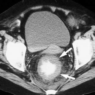 Figure 14. Diverticular abscess. CT scan obtained with oral and intravenous contrast material ...