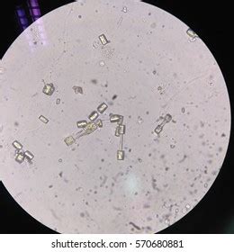 Microscopic Image Showing Calcium Oxalate Monohydrate Stock Photo