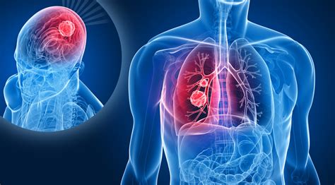 Lung Cancer Brain Metastases Multisite Focused Ultrasound And