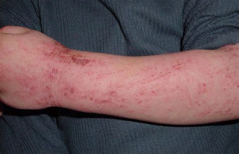 How Does Latex Fruit Syndrome Compare With Pollen Food Allergy Syndrome