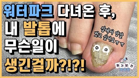 워터파크 다녀온 후 생긴 무좀발톱 깨끗하게 스케일링하기 무좀스케일링 발톱무좀 내성발톱 문제성발톱