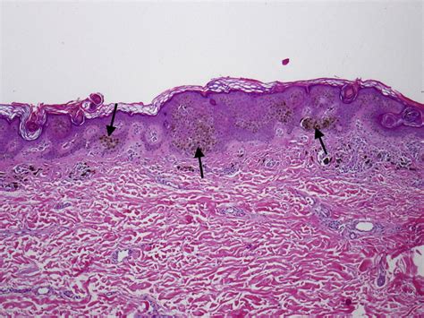 Clonal Seborrheic Keratosis Versus Epidermal Nevus Journal Of The