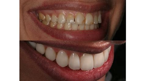 Composite Veneers Before And After Photos Kim