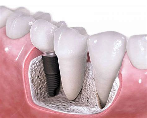 Impianto Dentale Costoprocedure E Consigli Per Risparmiare