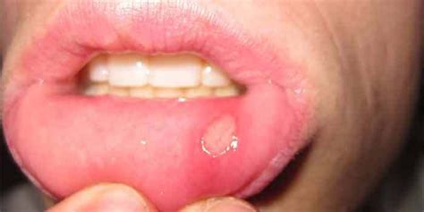 Home Remedies For Mouth Sores | Canker sore, Mouth sores, Cankers