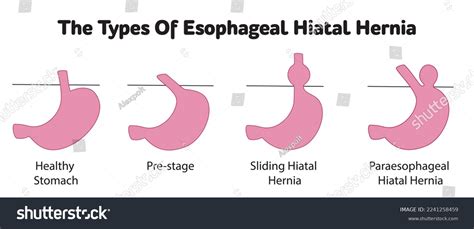 Hiatal Hernia Types