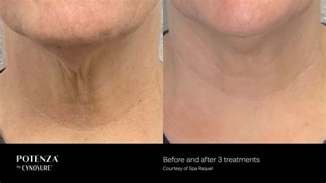 RF Microneedling Potenza In South Ogden North Logan UT