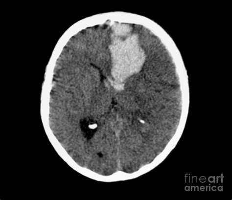 Brain Haemorrhage 18 By Zephyr Science Photo Library