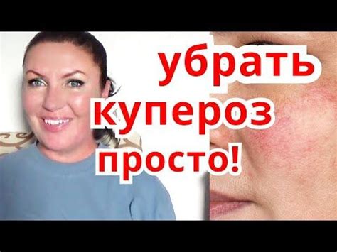 Избавит от КУПЕРОЗА Навсегда! Маски для Лица с Куперозом , Розоцея ...