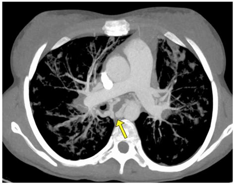 Jcm Free Full Text Role Of Bronchial Artery Embolization As Early