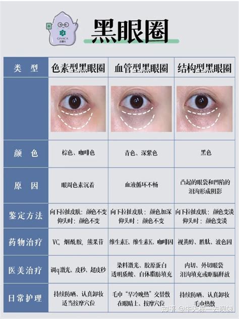 黑眼圈分类及改善攻略眼周抗衰之黑眼圈篇 知乎