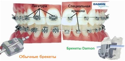 Самолигирующие брекеты в Минске │ Цена брекет-систем
